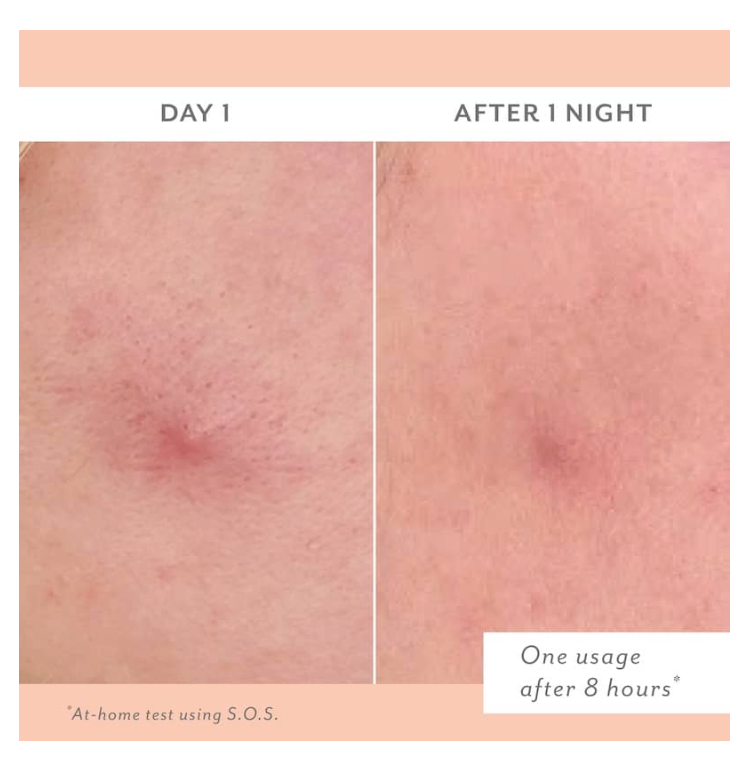 S.O.S. Totally Invisible Clarifying Liquid Patch